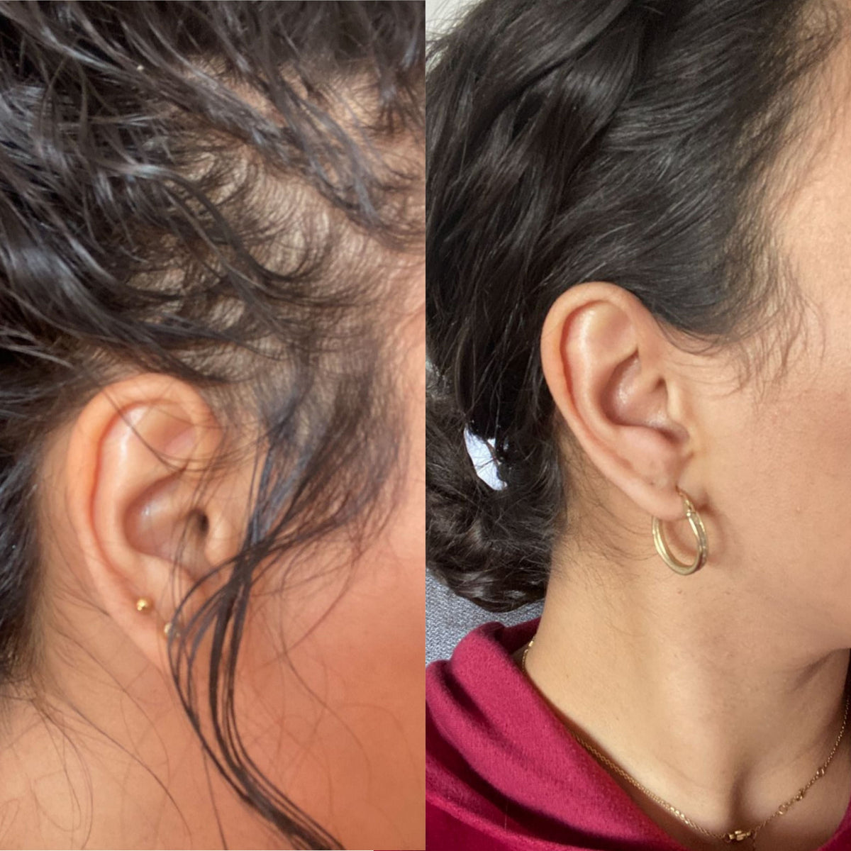Voor en na: terugtrekkende haarlijn, na 3 maanden serum